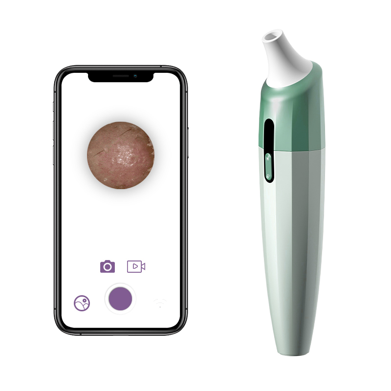 Visual blackhead remover with APP analyze